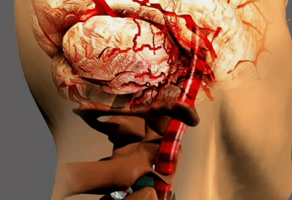 En tant qu'ostéochondrose cervicale, c'est dangereux