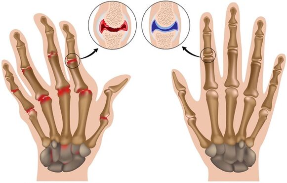 Déformation des doigts due à l'arthrose