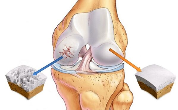 cartilage sain affecté par l'arthrose